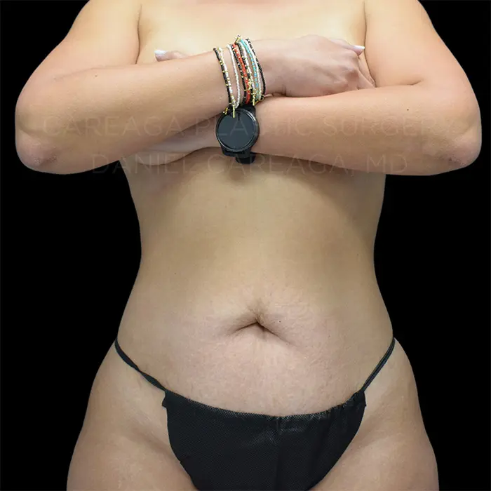 Tummy Tuck — before, actual Careaga patient