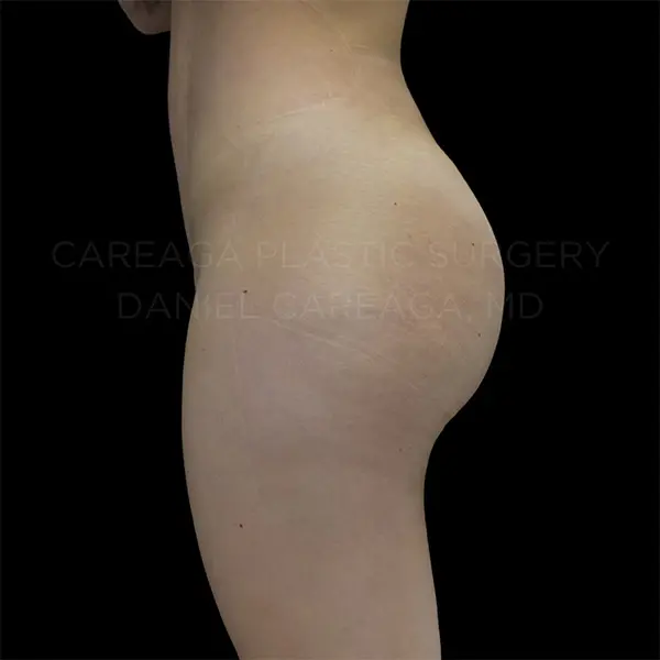 Brazilian Butt Lift — after, actual Careaga patient