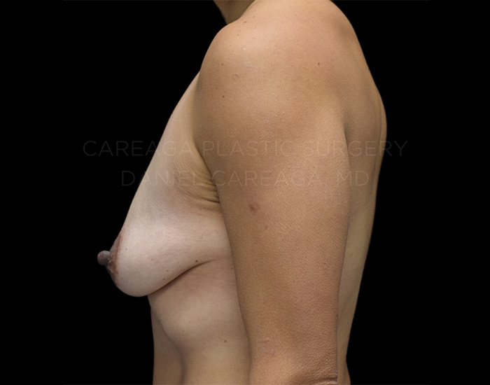 Augmentation + Lift — before, actual Careaga patient