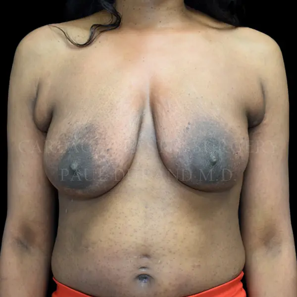 Breast Lift — before, actual Careaga patient