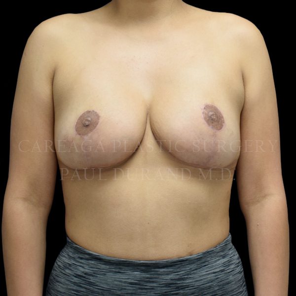 Breast Reduction — after, actual Careaga patient