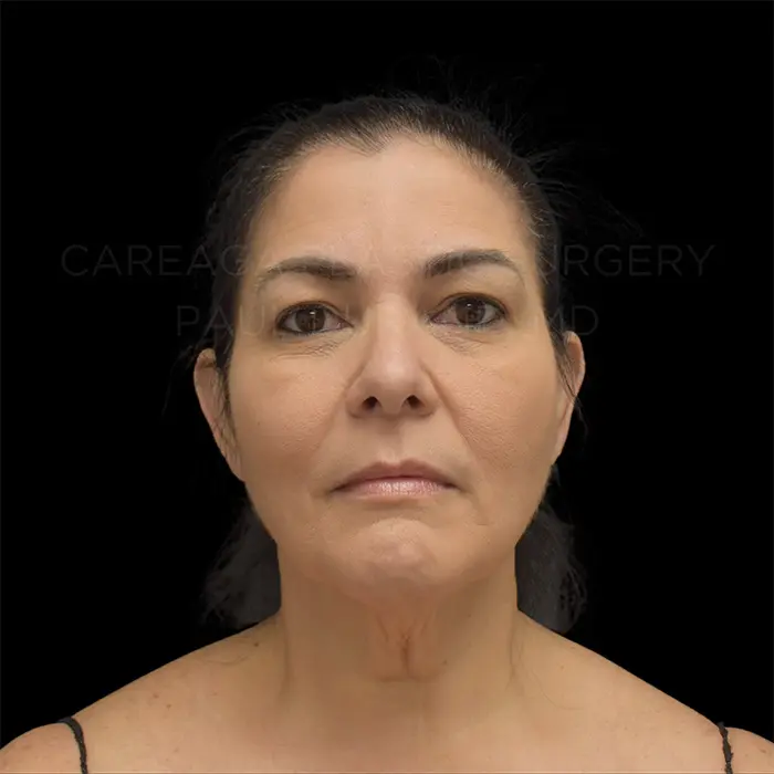 Deep Plane Facelift — before, actual Careaga patient