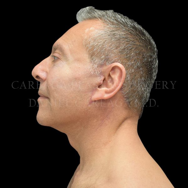 Deep Plane Facelift — after, actual Careaga patient