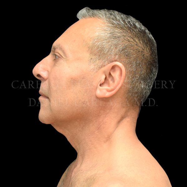 Deep Plane Facelift — before, actual Careaga patient