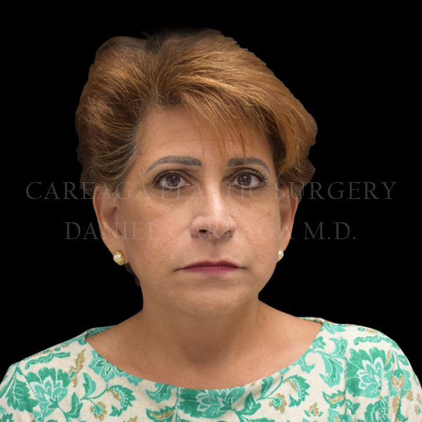 Deep Plane Facelift — after, actual Careaga patient