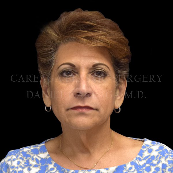 Deep Plane Facelift — before, actual Careaga patient