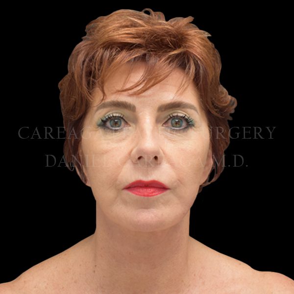 Deep Plane Facelift — after, actual Careaga patient
