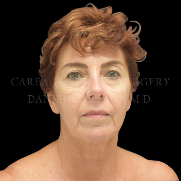 Deep Plane Facelift — before, actual Careaga patient