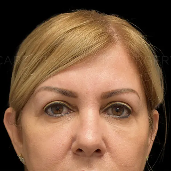 Eyelid Surgery — after, actual Careaga patient