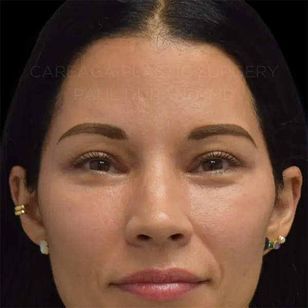Eyelid Surgery — after, actual Careaga patient