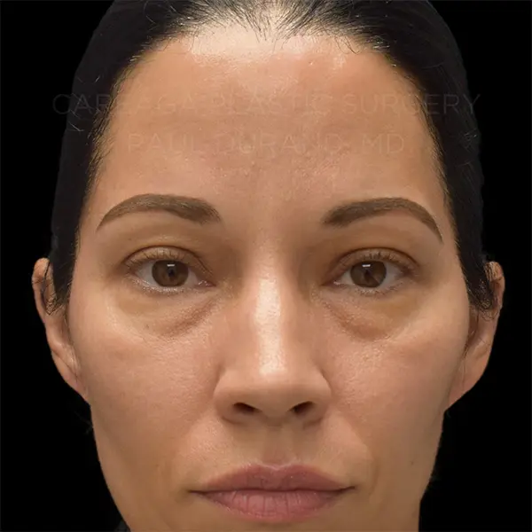 Eyelid Surgery — before, actual Careaga patient