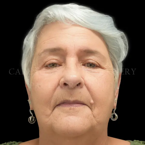Eyelid Surgery — after, actual Careaga patient