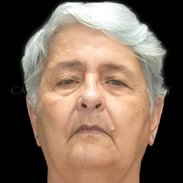 Eyelid Surgery — before, actual Careaga patient