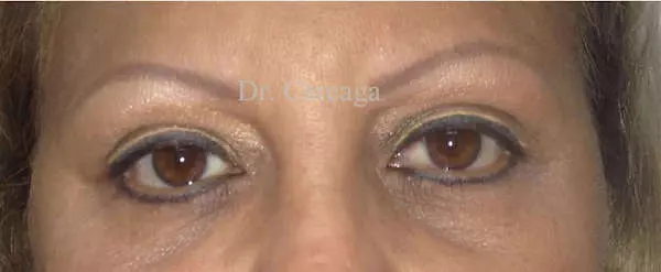 Eyelid Surgery — after, actual Careaga patient