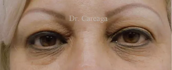 Eyelid Surgery — before, actual Careaga patient