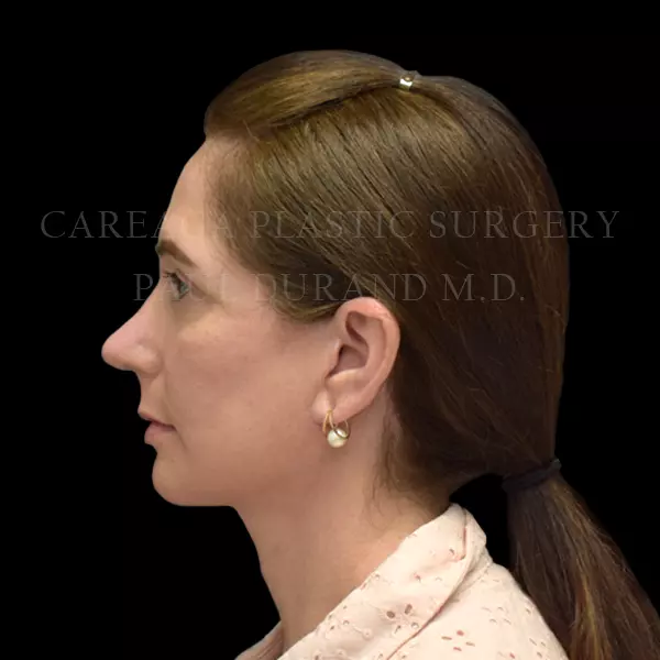 Rhinoplasty — after, actual Careaga patient