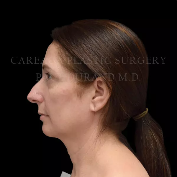 Rhinoplasty — before, actual Careaga patient