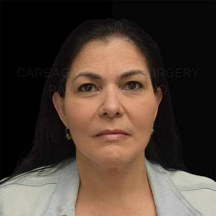 Facelift — after, actual Careaga patient