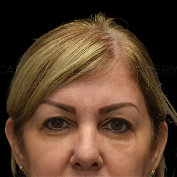 Eyelid Surgery — before, actual Careaga patient
