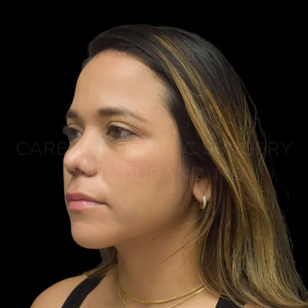 Revision Rhinoplasty — after, actual Careaga patient