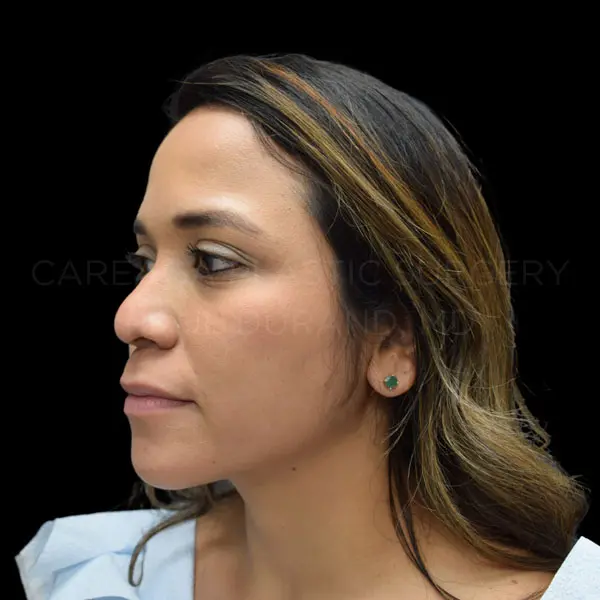 Revision Rhinoplasty — before, actual Careaga patient