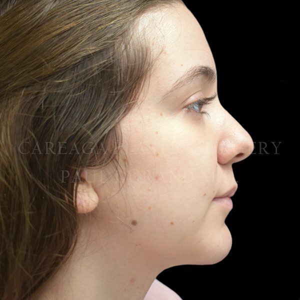 Chin Implant — after, actual Careaga patient