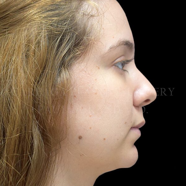 Chin Implant — before, actual Careaga patient