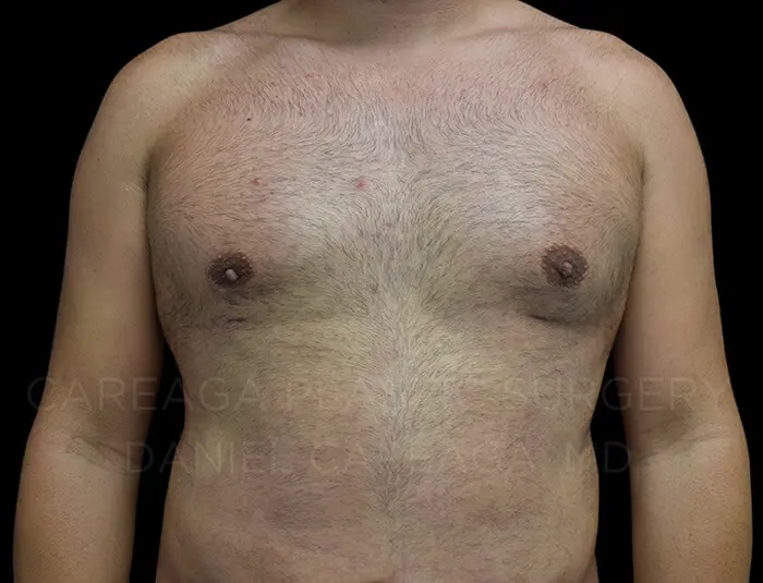Gynecomastia — after, actual Careaga patient