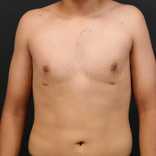 Gynecomastia — after, actual Careaga patient