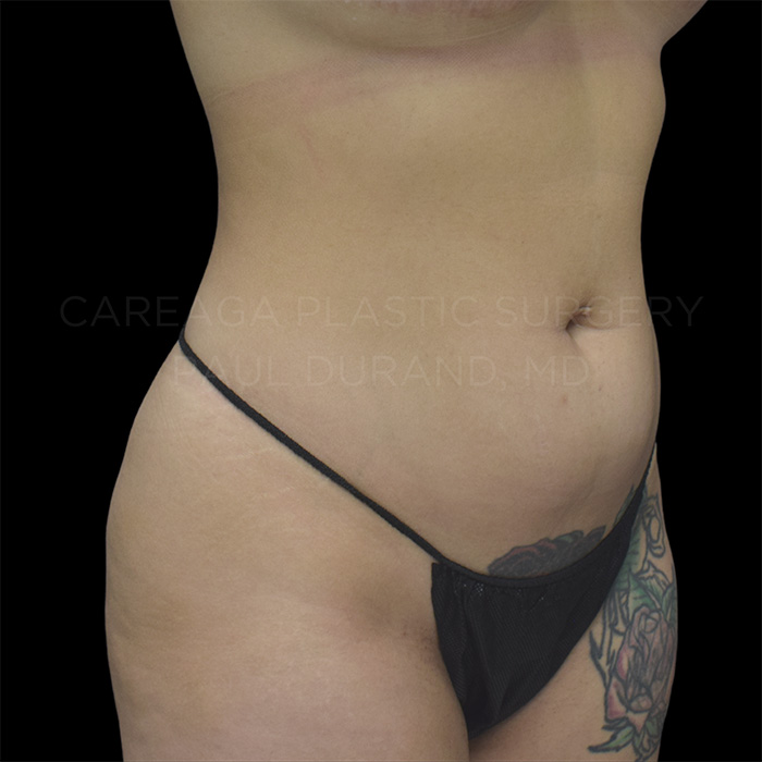 Lipo 360 — before, actual Careaga patient