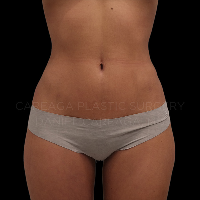 Lipo 360 — after, actual Careaga patient
