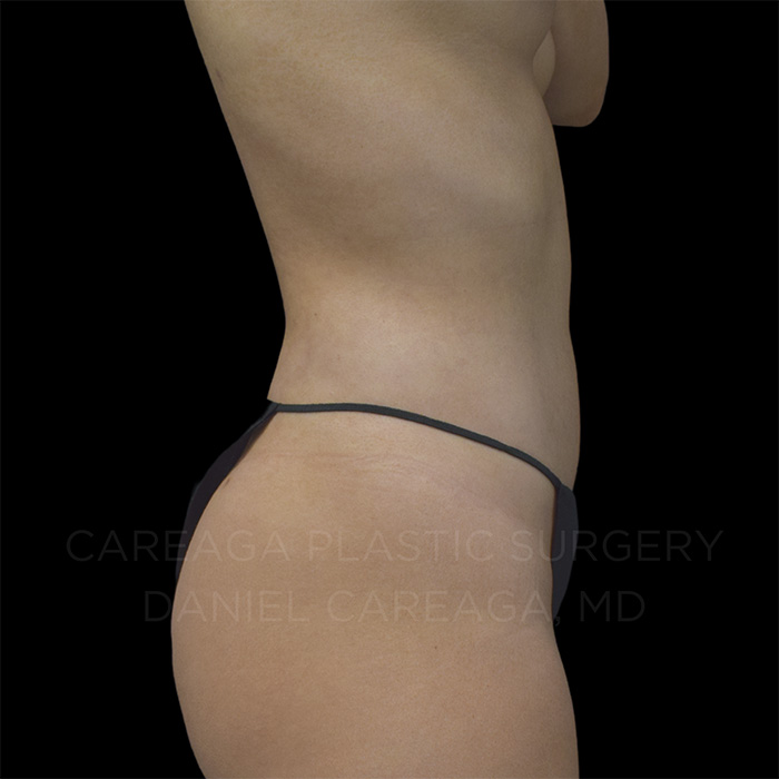 Lipo 360 — after, actual Careaga patient