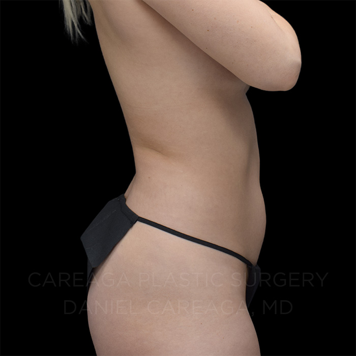 Lipo 360 — before, actual Careaga patient