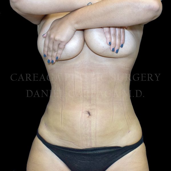 Lipo 360 — after, actual Careaga patient