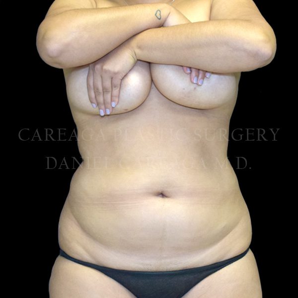 Lipo 360 — before, actual Careaga patient