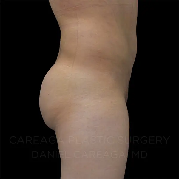 Lipo 360 + BBL — after, actual Careaga patient