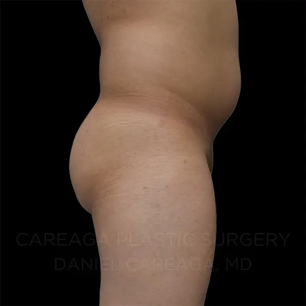Lipo 360 + BBL — before, actual Careaga patient
