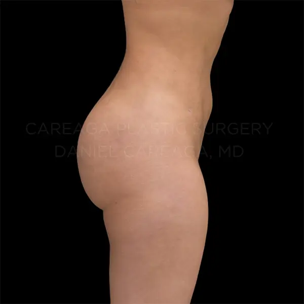 Lipo 360 + BBL — after, actual Careaga patient
