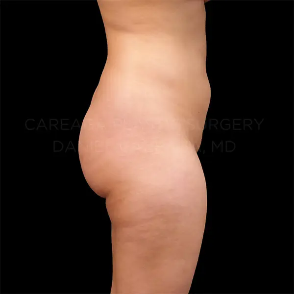 Lipo 360 + BBL — before, actual Careaga patient