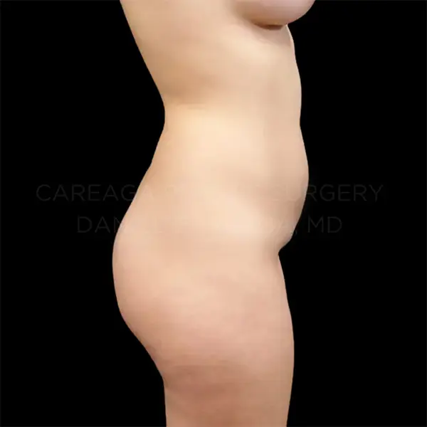 Lipo 360 + BBL — before, actual Careaga patient