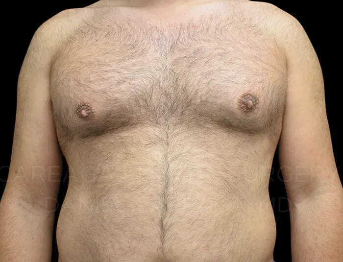 Gynecomastia — before, actual Careaga patient