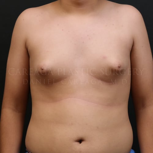 Gynecomastia — before, actual Careaga patient