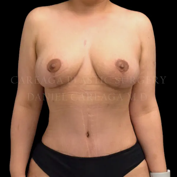 Mommy Makeover — after, actual Careaga patient