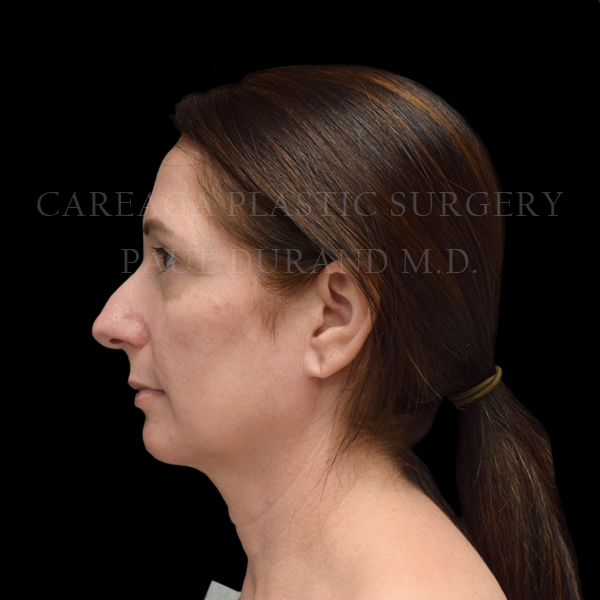 Rhinoplasty — before, actual Careaga patient