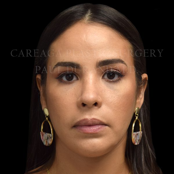 Rhinoplasty — after, actual Careaga patient