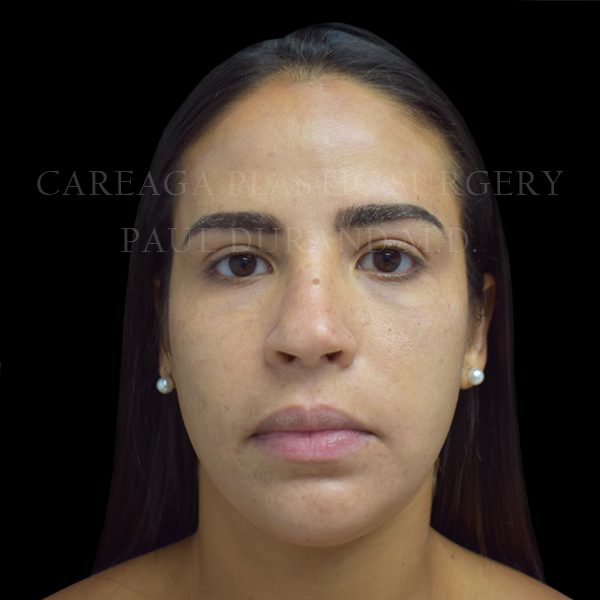 Rhinoplasty — before, actual Careaga patient