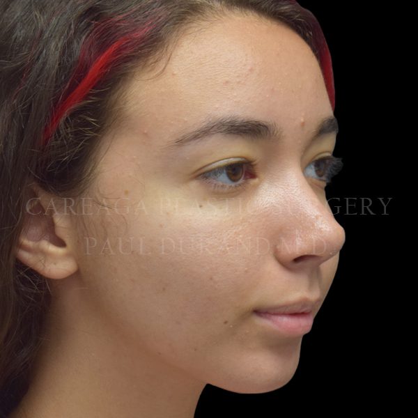 Rhinoplasty — after, actual Careaga patient