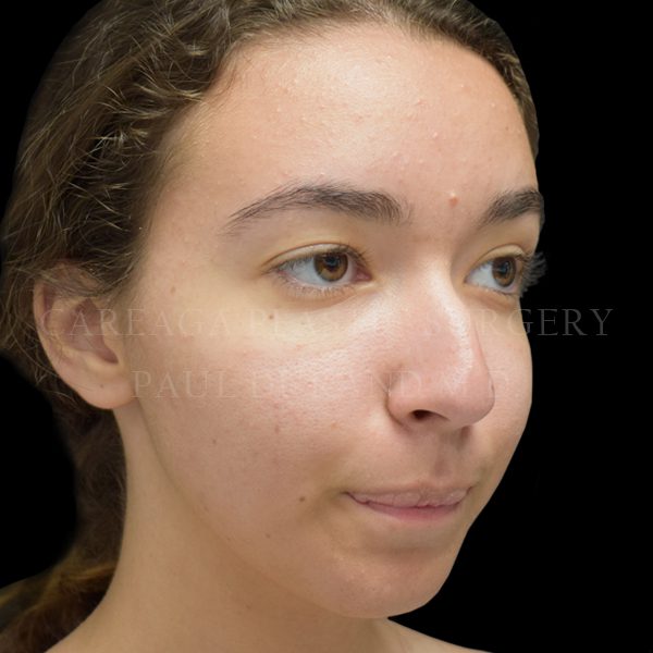 Rhinoplasty — before, actual Careaga patient