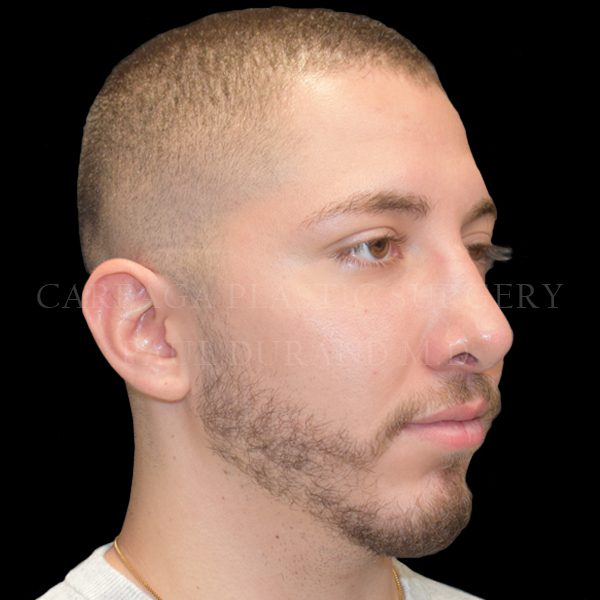 Rhinoplasty — after, actual Careaga patient