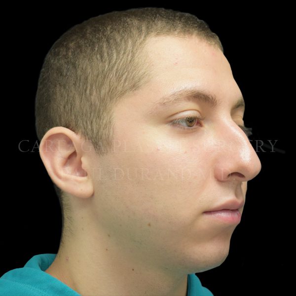 Rhinoplasty — before, actual Careaga patient